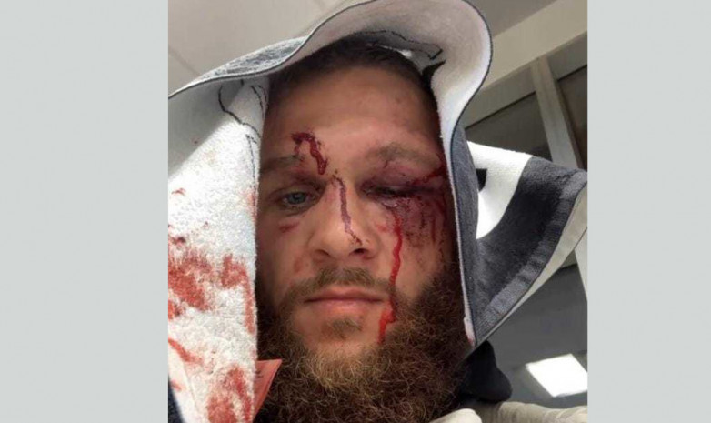UFC: Рафаэль Физиев показал лицо после боя с Гэтжи. Фото